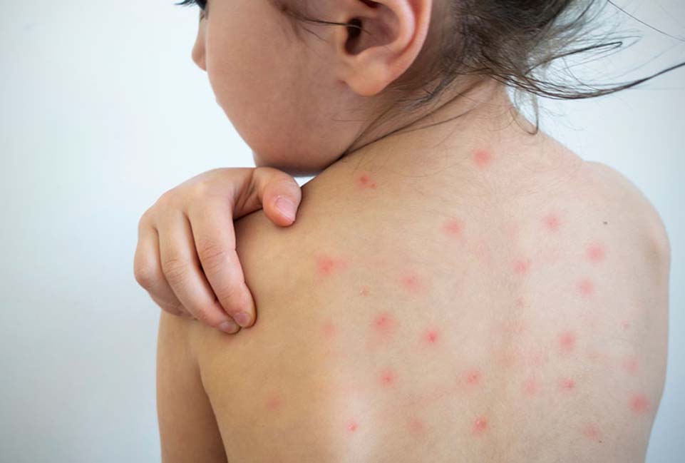Sarampión en Niños: Guía Completa de Prevención y Cuidados para Padres
